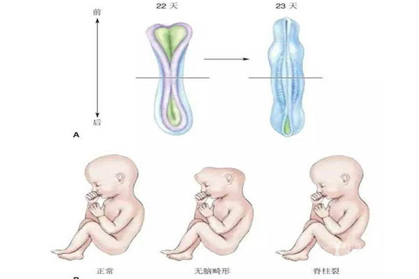 神经管畸形怎么查这5种检查是关键