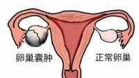 卵巢囊肿能怀孕吗？