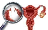 卵巢癌能怀孕吗？
