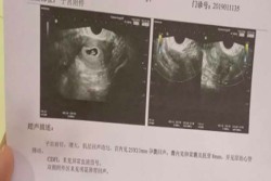 郑州市中医院试管婴儿 取卵10颗后肚子像气球怎么办