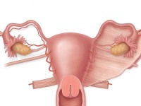 子宫肌瘤是什么原因导致的？