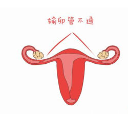 湖南省妇幼保健院治疗输卵管堵塞专家推荐