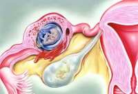 什么是输卵管炎症？
