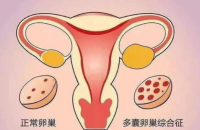 多囊卵巢能怀孕吗？