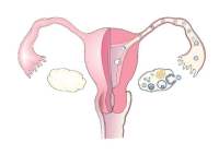 输卵管炎症什么原因造成的？