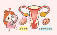 多囊卵巢吃什么药最好？