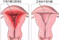 子宫内膜厚度过厚的影响