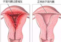 子宫内膜厚度过厚的影响