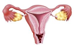 子宫内膜癌怎么办？