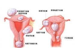 卵巢囊肿会自愈吗?