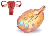 卵巢囊肿有什么症状？