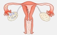 卵巢囊肿怎么调理？