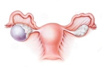 卵巢冠囊肿会自愈吗？