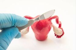 卵巢囊肿需要做手术吗？