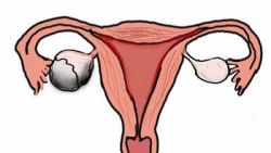 卵巢冠囊肿什么原因引起的？