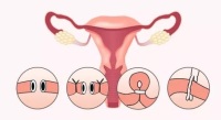 输卵管囊肿对女性身体有哪些危害？