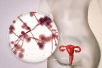 女性念珠菌感染是怎样引起的？