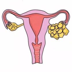 卵巢冠囊肿是什么情况？