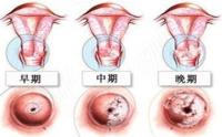 子宫内膜癌要注意什么？