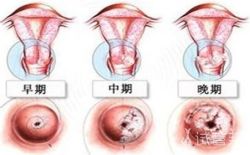 子宫内膜癌要注意什么？