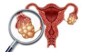 输卵管囊肿的备孕注意事项?