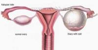 卵巢囊肿有什么症状?