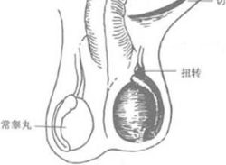 什么是睾丸右侧附睾囊肿?