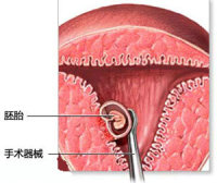 无痛人流费用多少?