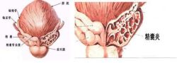 精囊炎能根治吗?