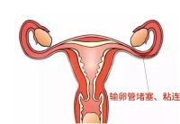 输卵管粘连治愈后能怀孕吗?