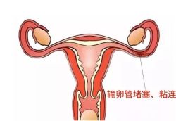 输卵管粘连治愈后能怀孕吗?