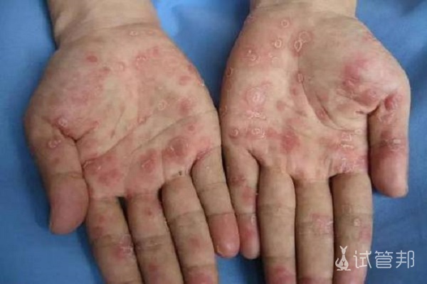 梅毒早期症状和图片