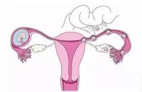 阴道横隔手术能治愈吗?