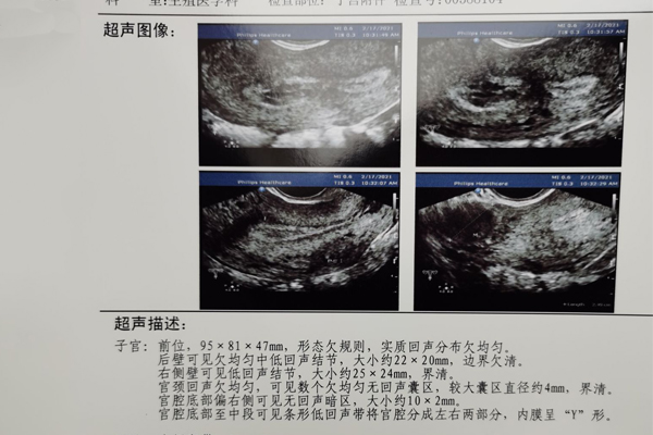 子宫肌瘤影响怀孕怎么办