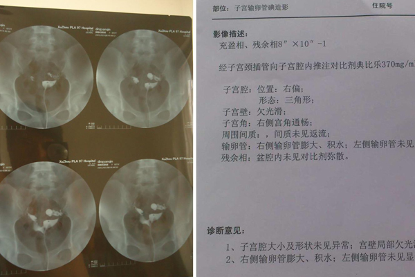 输卵管造影结果