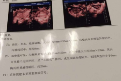 多囊卵巢导致不孕，重庆附二院试管婴儿终于成功