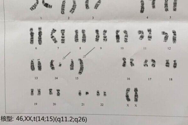 染色体异常导致胎停