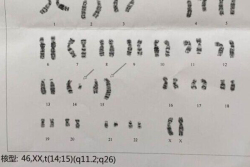 染色体异常导致胎停,33岁北京二代试管婴儿验孕成功