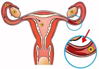 输卵管粘连是怎么引起的?