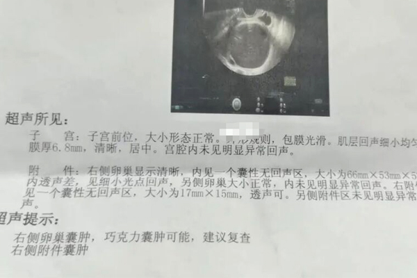 be4b028e5f369aa946899ebebaf9d821.png 巧克力囊肿导致怀不上