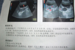 巧克力囊肿一直怀不上，惠州市中心人民医院试管好孕