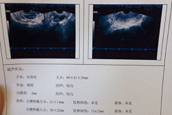 子宫内膜异位，甘肃省妇幼保健院试管婴儿