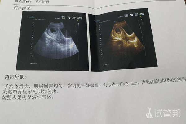 f0b454eeac9568c25c1fc142d1f88ca8.jpg 孕囊看男女有科学依据吗