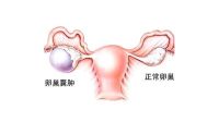 卵巢囊肿需要切除吗?