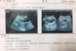 在沈阳盛京医院试管婴儿，成功怀上二胎！