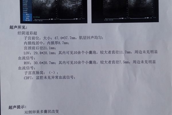 多囊卵巢综合症可以做试管婴儿吗