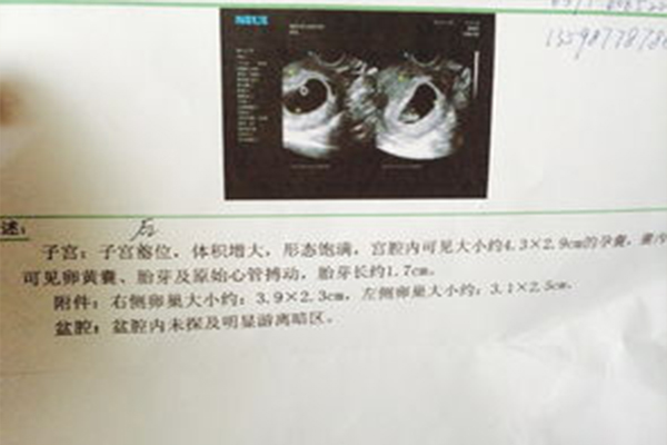 5408fa1bbf7ace331a1213682048f835.jpg 40-50天孕囊看男女的原理是什么