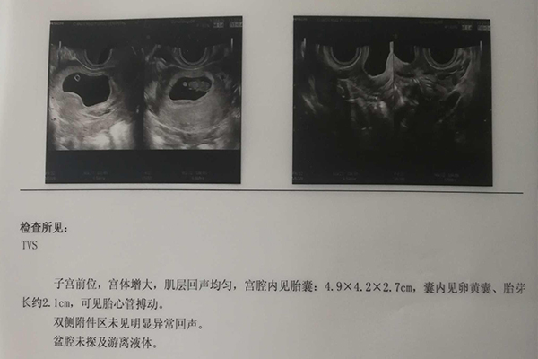 孕囊看男女中间数值小怎么算