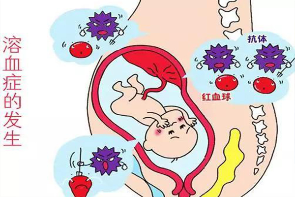 rh阴性血(熊猫血)二胎的危害