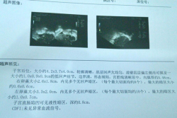 卵巢早衰情况差，沈阳市妇婴医院试管婴儿验孕成功